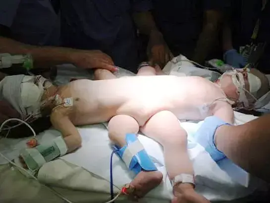 תאומים סיאמיים בערב הסעודית (צילום מסך) תאומים סיאמיים בערב הסעודית (צילום מסך)