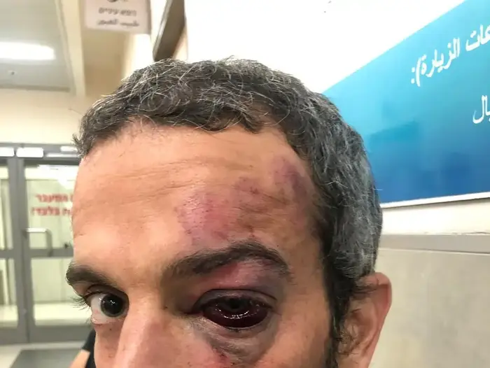 ניק פנקס ממושב ברמת הגולן שטוען כי הרביצו לו לאחר שהעיר למתארחים בצימר לא לקטוף מהמטע שלו, ספטמבר 2019 (באדיבות המצולמים) ניק פנקס ממושב ברמת הגולן שטוען כי הרביצו לו לאחר שהעיר למתארחים בצימר לא לקטוף מהמטע שלו, ספטמבר 2019 (באדיבות המצולמים)