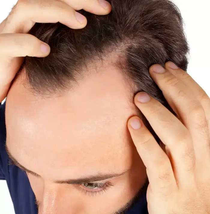 התקרחות (ShutterStock) התקרחות (ShutterStock)