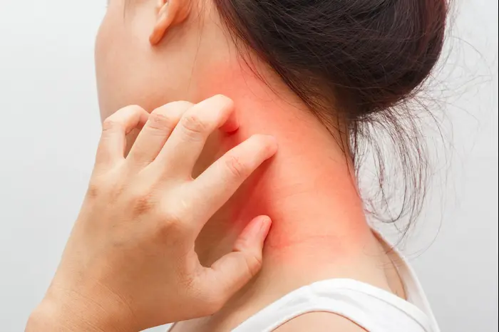פריחה בצוואר (ShutterStock) פריחה בצוואר (ShutterStock)