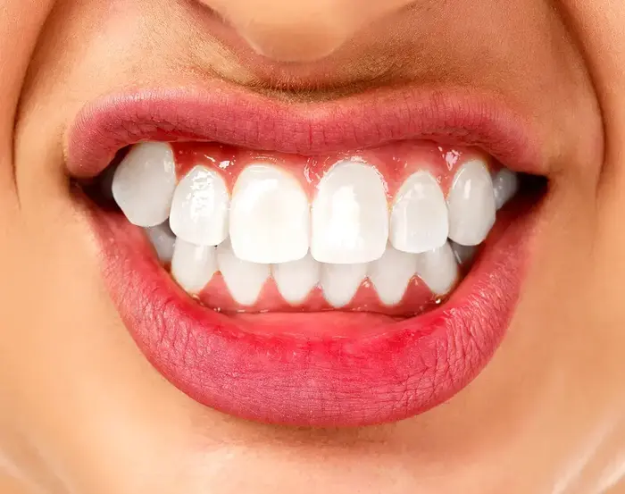 חריקת שיניים (ShutterStock) חריקת שיניים (ShutterStock)