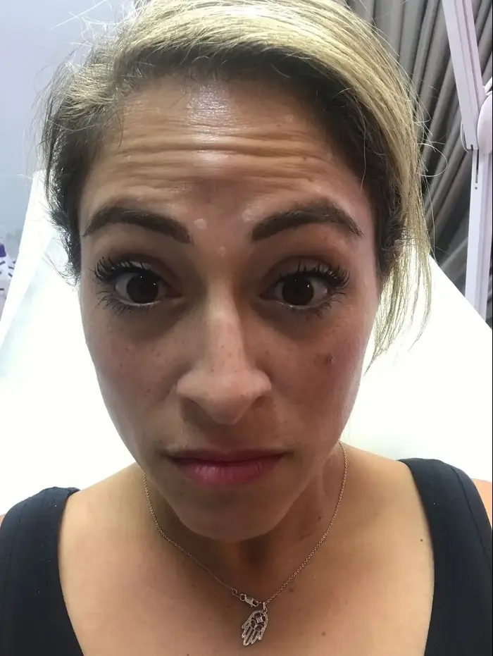 ליהיא גרינר בטיפול בוטוקס (יח"צ)