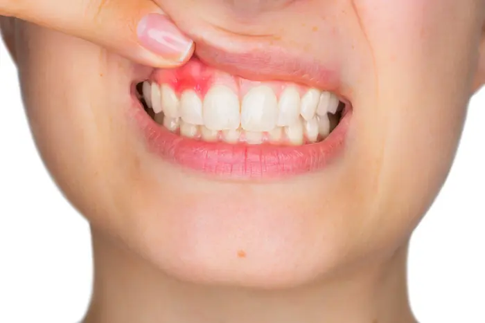 מחלת חניכיים (ShutterStock)