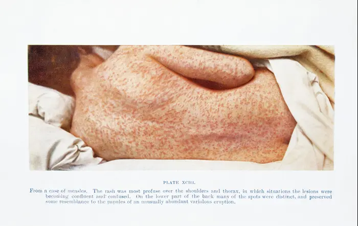 גב של אישה חולה בחצבת (אתר רשמי , Wellcome Collection)