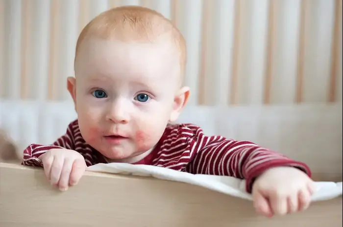 תינוקת עם אטופיק דרמטיטיס (ShutterStock) תינוקת עם אטופיק דרמטיטיס (ShutterStock)