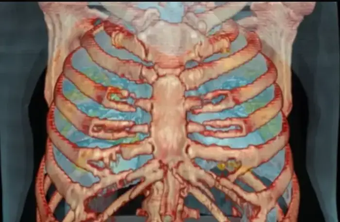 הדמיית CT של ריאות פגועות של חולה קורונה (צילום מסך , יו טיוב) הדמיית CT של ריאות פגועות של חולה קורונה (צילום מסך , יו טיוב)