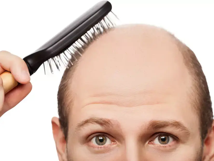 התקרחות (ShutterStock)