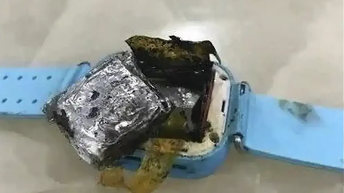 Scary The smartwatch exploded 4yearold suffers from severe burns