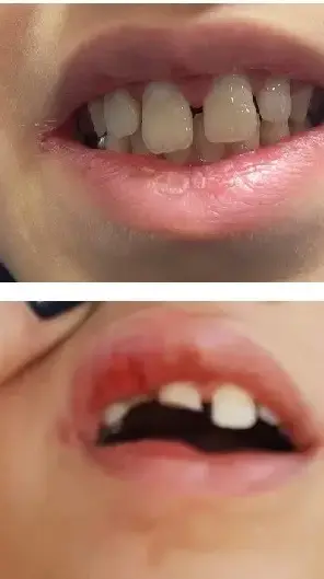 תיקון שבר שיניים תיקון שבר שיניים
