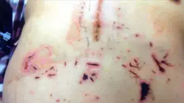 מתוך סרטון יוטיוב על אדם הטוען כי במהלך ניתוח שעבר במדינת דרום דקוטה השאירו על בטנו צלקת בצורת האותיות KKK (קו-קלאקס-קלאן), יולי 2012