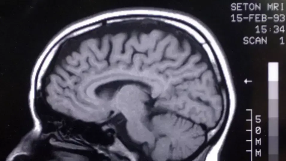 תצלום MRI של מוח אנושי