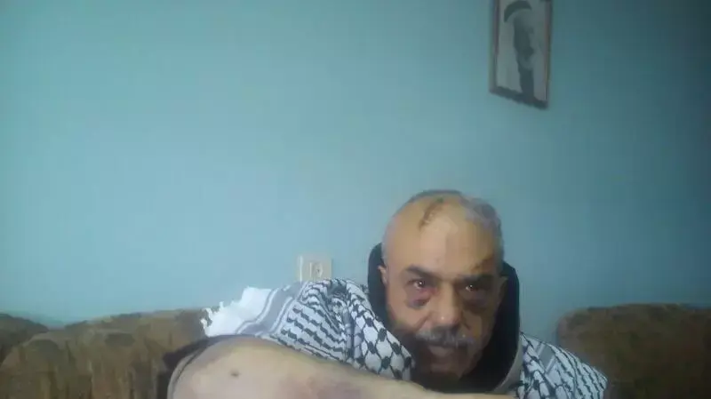 אחמד אל-זיר מהכפר סילוואד שהוכה על ידי מתנחלים צעירים