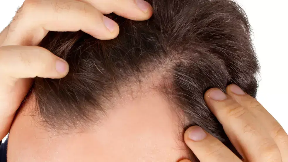 התקרחות התקרחות