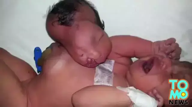 תינוקת שנולדה בהודו עם ראש טפילי מחובר לבטן עברה ניתוח מוצלח מאי 2014 תינוקת שנולדה בהודו עם ראש טפילי מחובר לבטן עברה ניתוח מוצלח מאי 2014