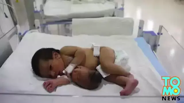 תינוקת שנולדה בהודו עם ראש טפילי מחובר לבטן עברה ניתוח מוצלח מאי 2014 תינוקת שנולדה בהודו עם ראש טפילי מחובר לבטן עברה ניתוח מוצלח מאי 2014