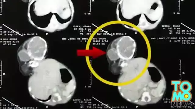 תינוקת שנולדה בהודו עם ראש טפילי מחובר לבטן עברה ניתוח מוצלח מאי 2014 תינוקת שנולדה בהודו עם ראש טפילי מחובר לבטן עברה ניתוח מוצלח מאי 2014