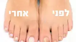 פטרת הציפורניים