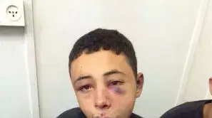 בן דודו של מוחמד אבו חדיר לאחר שהוכה על ידי שוטרי מג"ב בן דודו של מוחמד אבו חדיר לאחר שהוכה על ידי שוטרי מג"ב