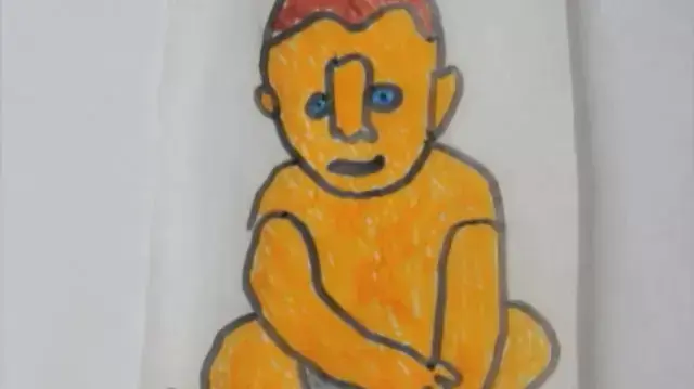 תסמונת פראדר-ווילי תסמונת פראדר-ווילי