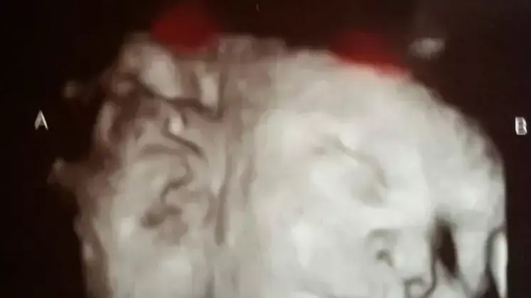 תאומים סיאמיים עם גוף אחד ושני ראשים נולדו באטלנטה, 4 בדצמבר 2014