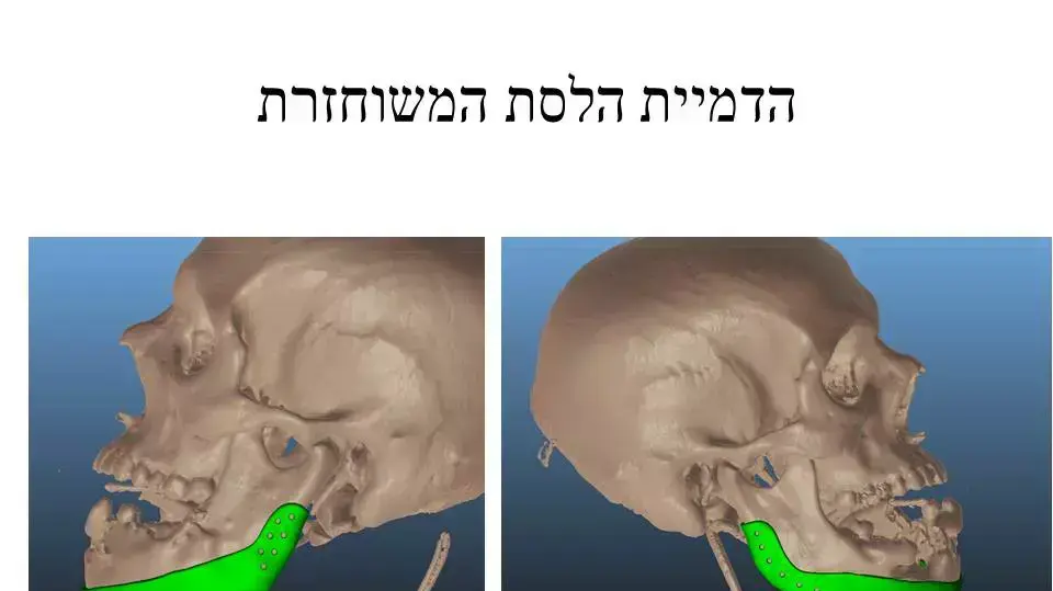 תמונות הדמיה של לפני ואחרי שחזור הלסת של הפצוע הסורי, ינואר 2015.