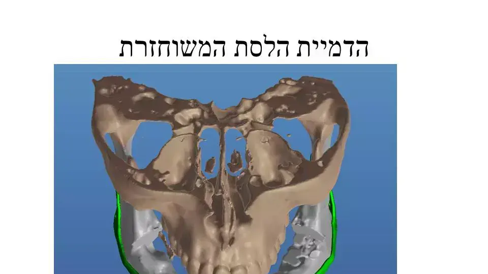 תמונות הדמיה של לפני ואחרי שחזור הלסת של הפצוע הסורי, ינואר 2015. תמונות הדמיה של לפני ואחרי שחזור הלסת של הפצוע הסורי, ינואר 2015.