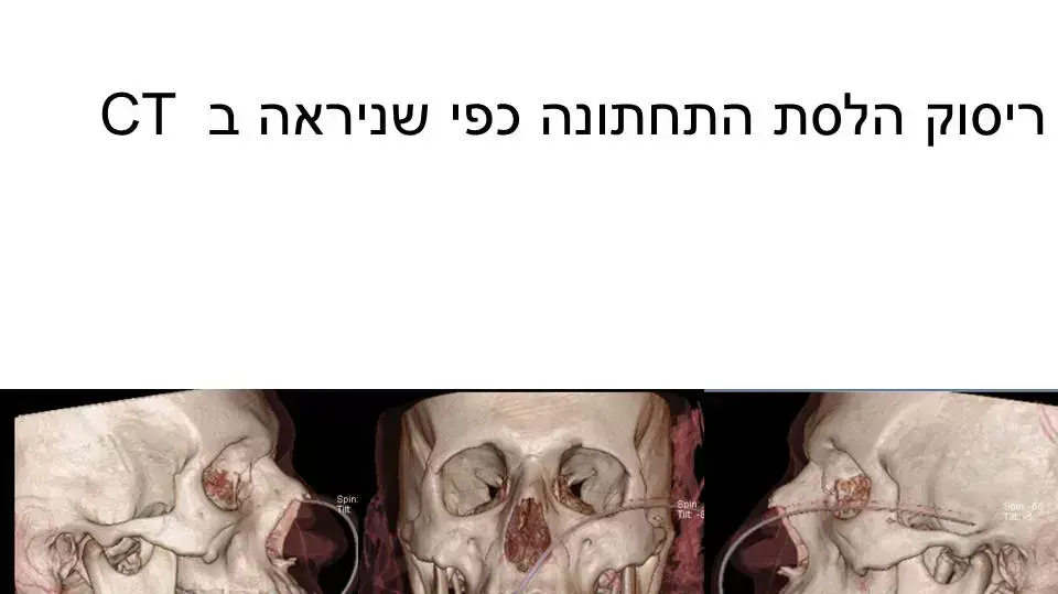 תמונות הדמיה של לפני ואחרי שחזור הלסת של הפצוע הסורי, ינואר 2015. תמונות הדמיה של לפני ואחרי שחזור הלסת של הפצוע הסורי, ינואר 2015.