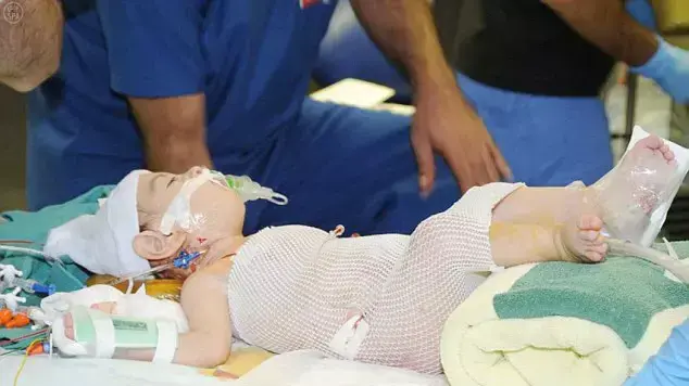 תאומים סיאמיים בערב הסעודית תאומים סיאמיים בערב הסעודית