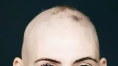 פרויקט התקרחות נשית פרויקט התקרחות נשית