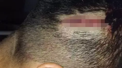 תמונת פציעתו של רן אייזקוביץ', שהותקף על ידי נערים ברחובות על רקע הומופובי תמונת פציעתו של רן אייזקוביץ', שהותקף על ידי נערים ברחובות על רקע הומופובי