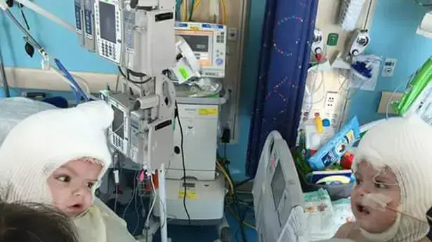 ג'ייסון ואניאס מקדונלד תאומים סיאמיים שהיו מחוברים בראש והופרדו רואים זה את זה בפעם הראשונה ג'ייסון ואניאס מקדונלד תאומים סיאמיים שהיו מחוברים בראש והופרדו רואים זה את זה בפעם הראשונה