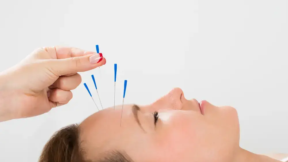 דיקור סיני קוסמטי דיקור סיני קוסמטי