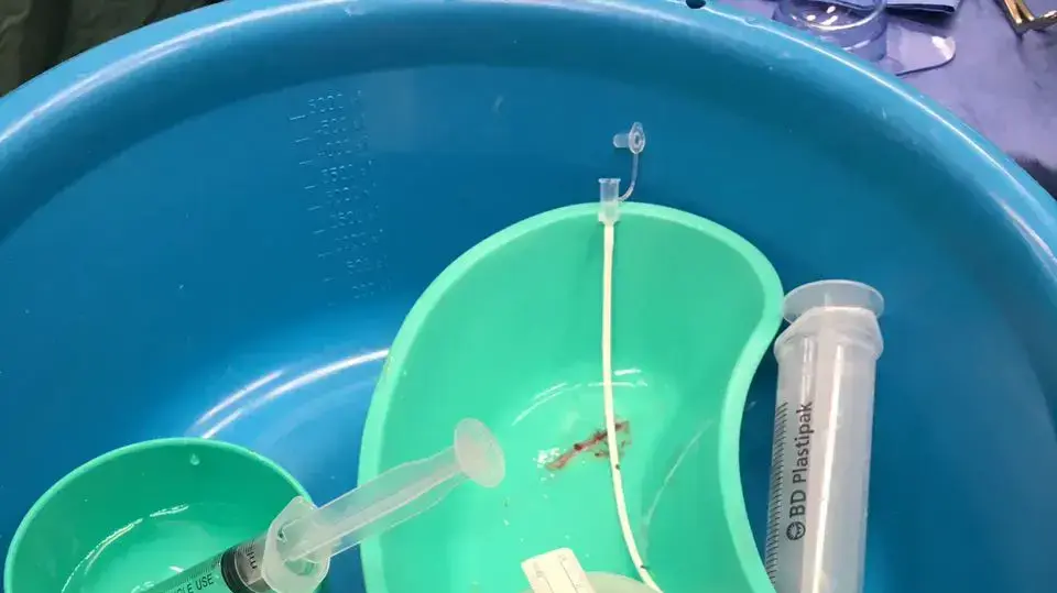 ציסטה שהוסרה ממוחו של ילד בדרום הארץ, 26 בפברואר 2017 ציסטה שהוסרה ממוחו של ילד בדרום הארץ, 26 בפברואר 2017
