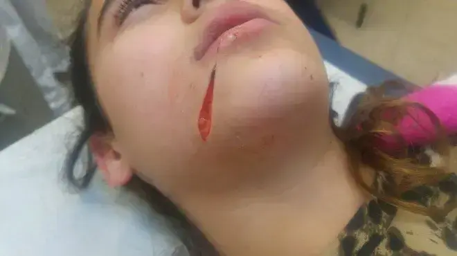 עדן לוי, נפצעה מספל שהושלכה עליה על ידי חרדי בבני ברק. מרץ 2017 עדן לוי, נפצעה מספל שהושלכה עליה על ידי חרדי בבני ברק. מרץ 2017
