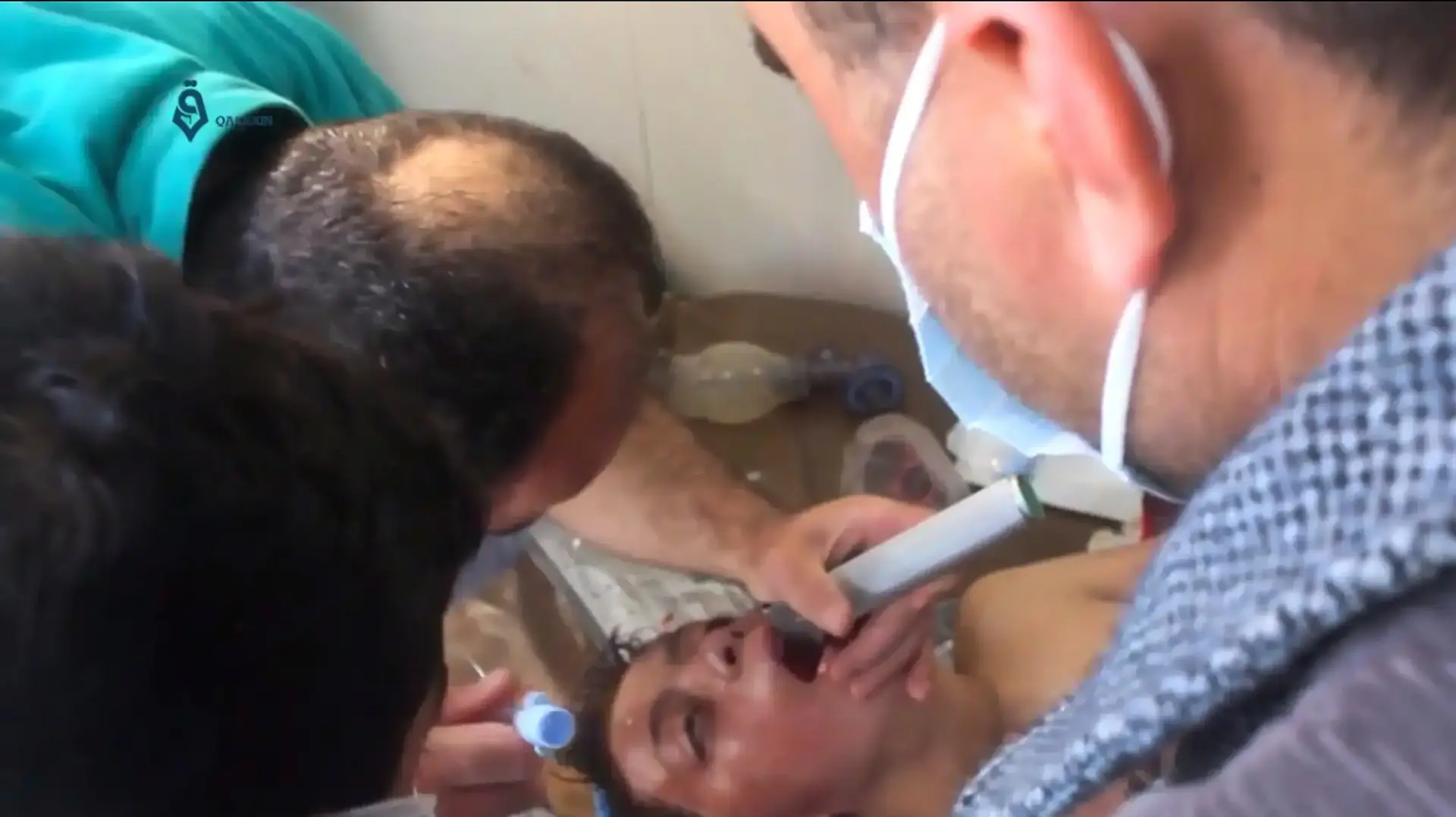 פצוע מהתקפה האווירית בעיירה חאן שייחון שכללה שימוש בגז סארין מטופל על ידי רופא, סוריה. 4 באפריל 2017 פצוע מהתקפה האווירית בעיירה חאן שייחון שכללה שימוש בגז סארין מטופל על ידי רופא, סוריה. 4 באפריל 2017
