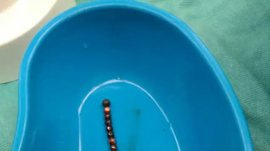 בן שנתיים בלע שרשרת מגנטים שהוצאה בניתוח בשניידר, צילום: דוברות שניידר בן שנתיים בלע שרשרת מגנטים שהוצאה בניתוח בשניידר, צילום: דוברות שניידר