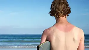 כוויית שמש כוויית שמש