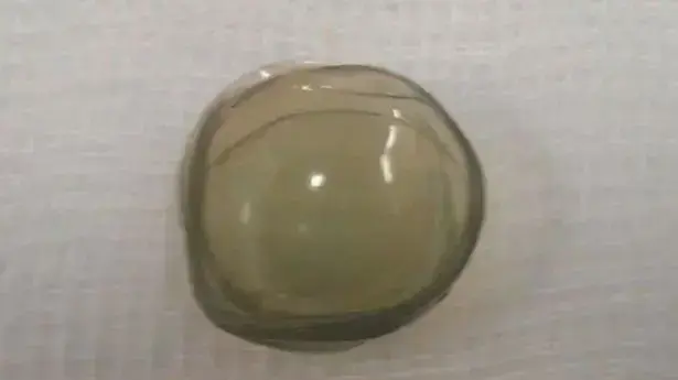 עדשות מגע נמצאו בעיניה של מטופלת עדשות מגע נמצאו בעיניה של מטופלת