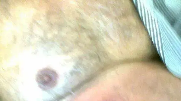 עקיצת העכביש ממנה סבל יורם שייך תושב טבריה שטופל בבית החולים רמב"ם, אוגוסט 2017 עקיצת העכביש ממנה סבל יורם שייך תושב טבריה שטופל בבית החולים רמב"ם, אוגוסט 2017