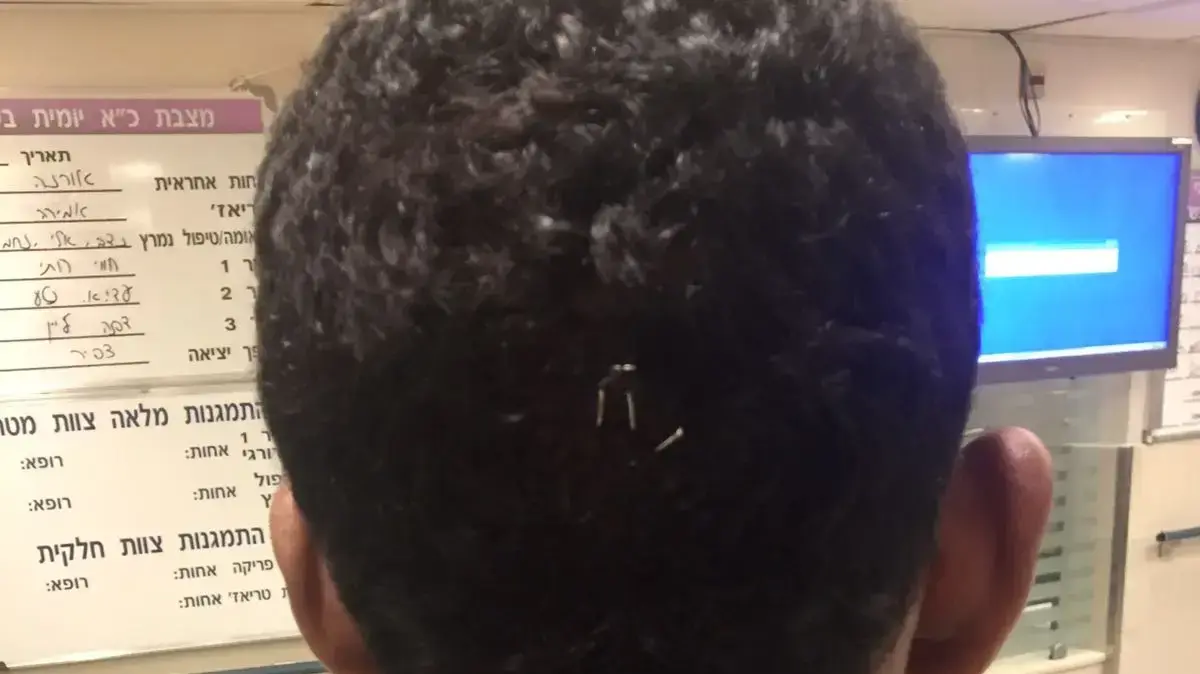 המאבטח שנחבל באירוע שהתרחש באיכלוב בו 5 גברים הכו מאבטחים 28.9.17 המאבטח שנחבל באירוע שהתרחש באיכלוב בו 5 גברים הכו מאבטחים 28.9.17