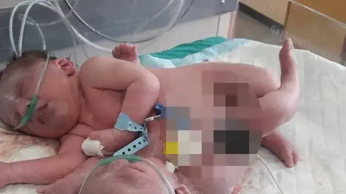 תאומים סיאמים ביה"ח שיפא