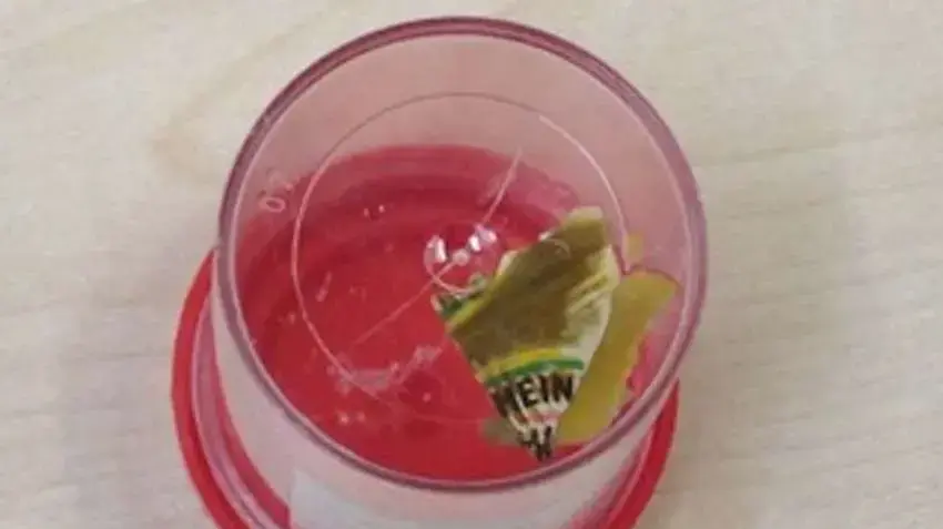 שקית קטשופ שהוצאה מהמעי של אישה לאחר 6 שנים שחשבו שיש לה קרוהן שקית קטשופ שהוצאה מהמעי של אישה לאחר 6 שנים שחשבו שיש לה קרוהן