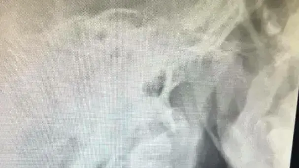 צילום רנטגן של ילד שנחנק מענבים צילום רנטגן של ילד שנחנק מענבים