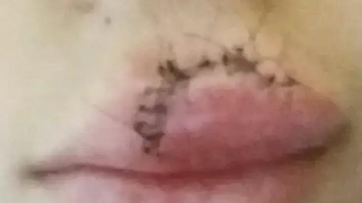 ילדה שננשכה בפניה ובשפה על ידי כלב בבית הספר ברמת השרון ילדה שננשכה בפניה ובשפה על ידי כלב בבית הספר ברמת השרון