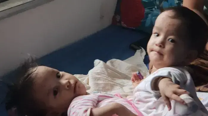 תאומות סיאמיות מבהוטן שנותחו באוסטרליה