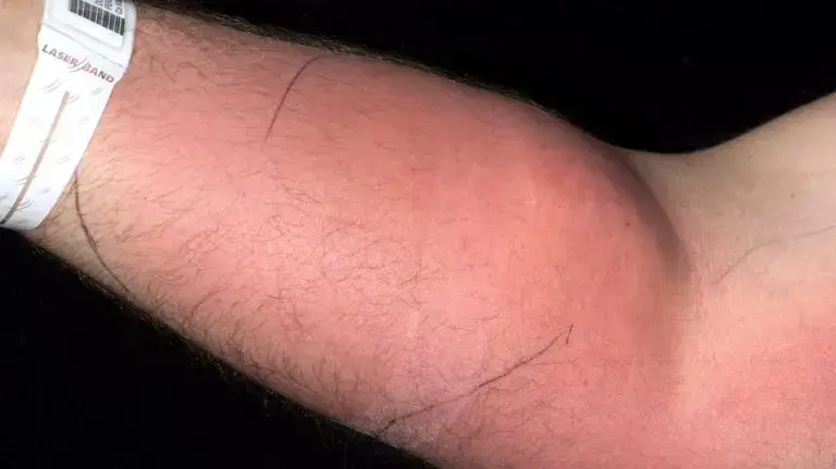 זרוע עם זיהום תת עורי של גבר שהזריק לעצמו נוזל זרע זרוע עם זיהום תת עורי של גבר שהזריק לעצמו נוזל זרע