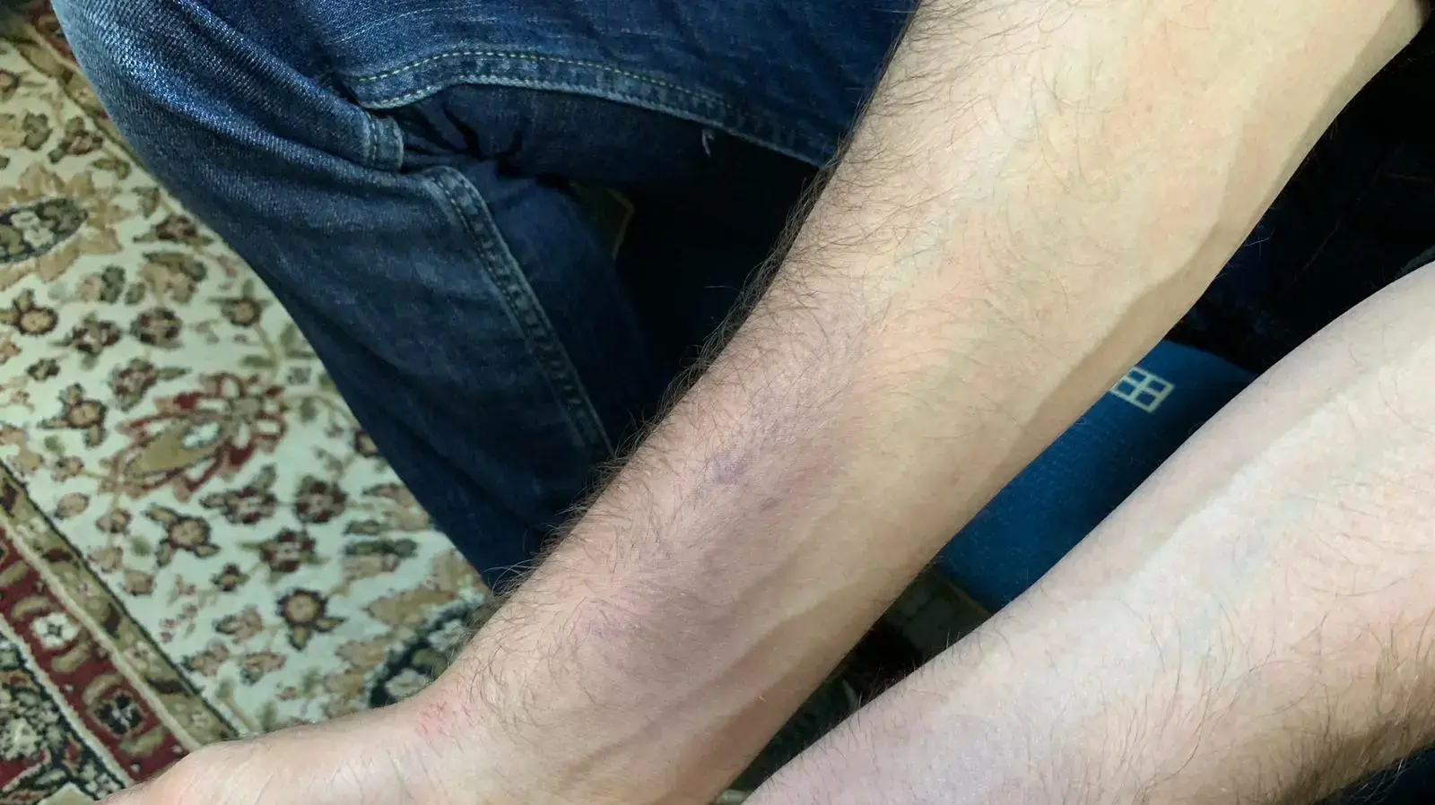 חבלות של צעיר ערבי שהוכה לדבריו על ידי שוטרים בחיפה חבלות של צעיר ערבי שהוכה לדבריו על ידי שוטרים בחיפה
