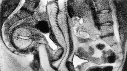 MRI של קיום יחסי מין
