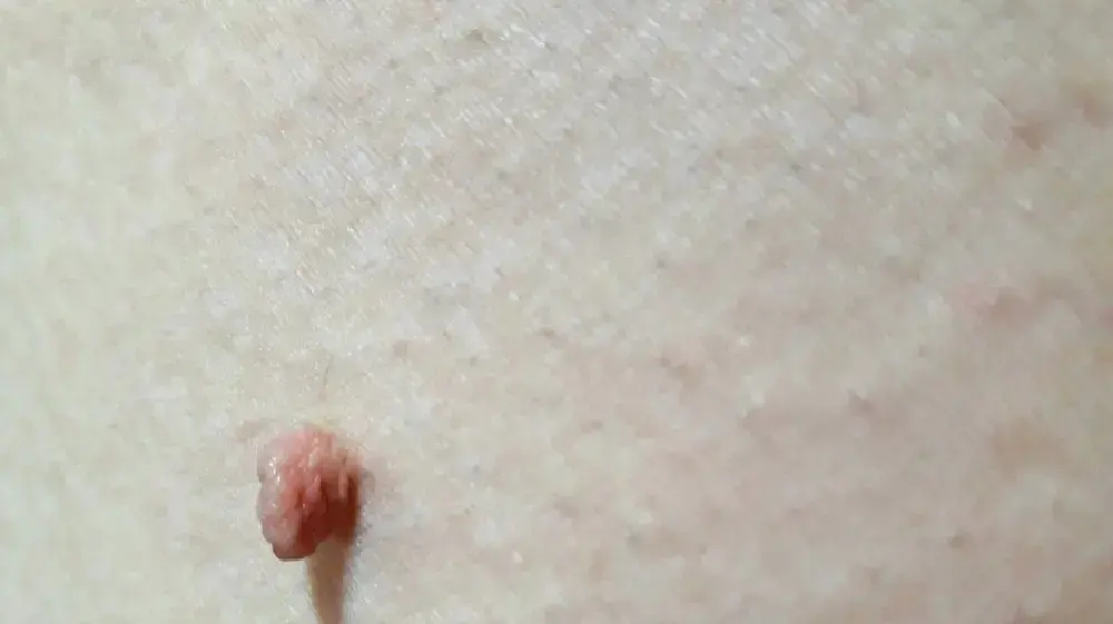 נגע בעור מסוג סרח עור skin tag נגע בעור מסוג סרח עור skin tag