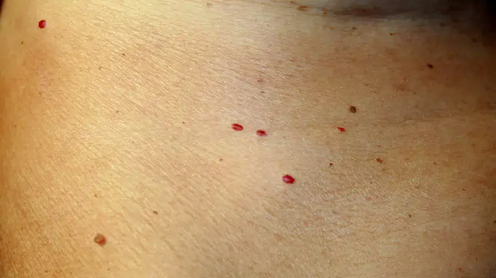 נגע בעור מסוג אנגיומה דובדבן Cherry angioma נגע בעור מסוג אנגיומה דובדבן Cherry angioma